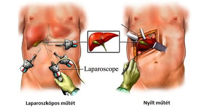 MOM Szent Magdolna Magánklinika - Laparoszkópos műtét bemutatása